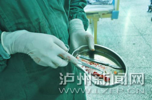 医生从张先生阑尾取出的鸡骨头